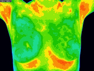 Thermography chest